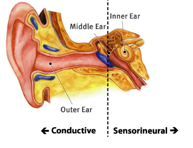 Conductive Hearing Loss