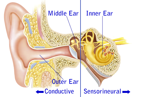 Sensorineural Hearing Loss