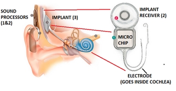 Cochlear Implant